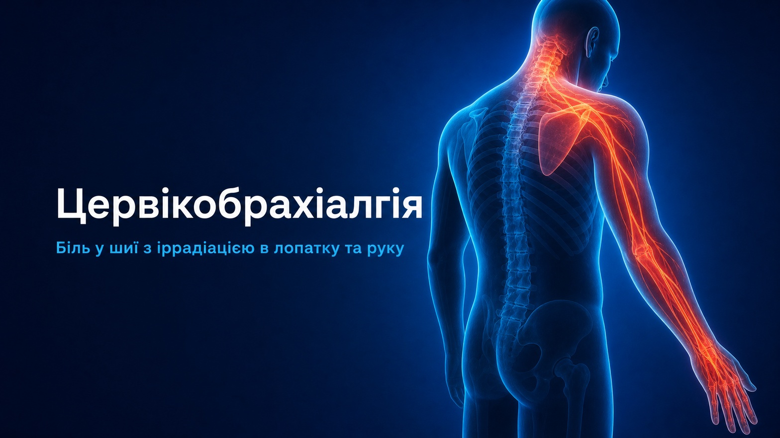 Цервікобрахіалгія — біль у шиї з іррадіацією в лопатку та руку