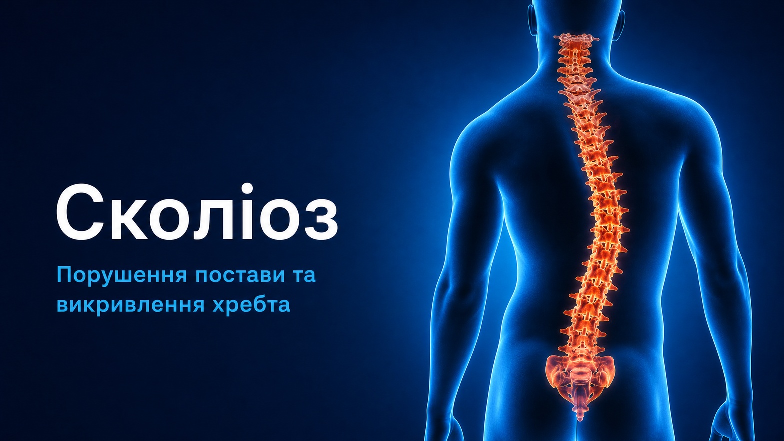 Сколіоз — порушення постави та викривлення хребта